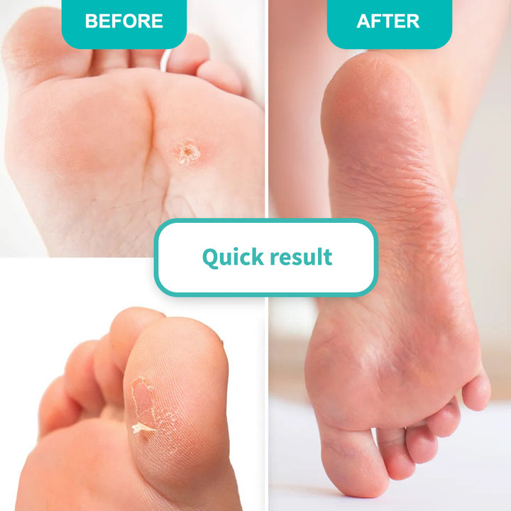 Foot Callus Softening Gel For Topical Application Soft Blade - 100 ml