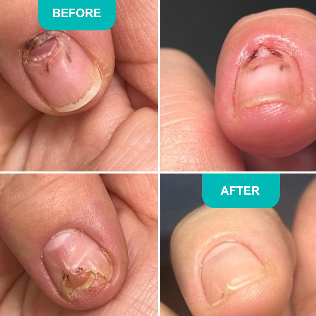 Oil for damaged nail plate - 30 ml