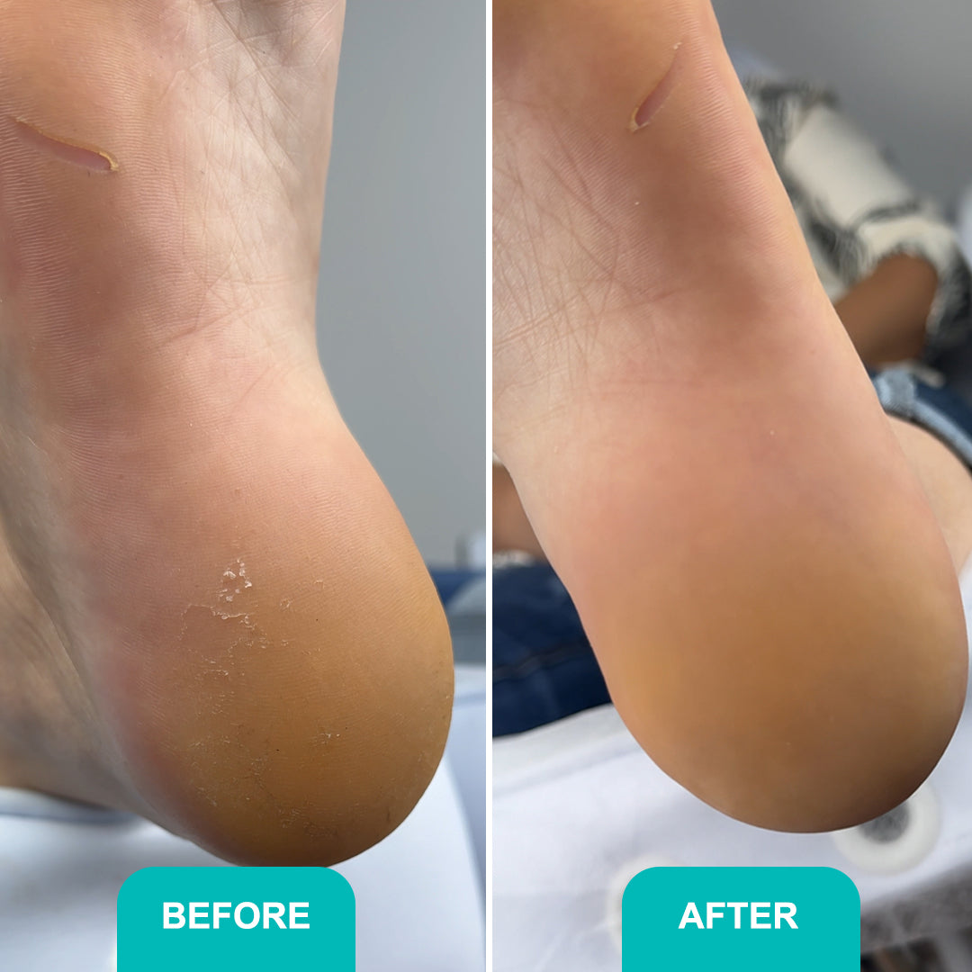 Сalluse and corns softening gel Soft Blade - 200 ml