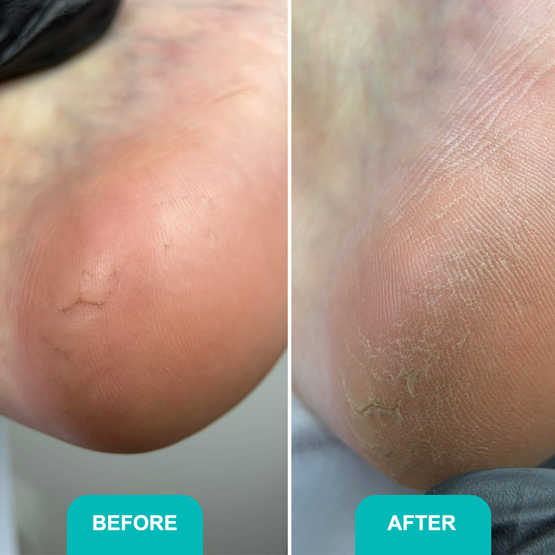 Сalluse and corns softening gel Soft Blade - 200 ml