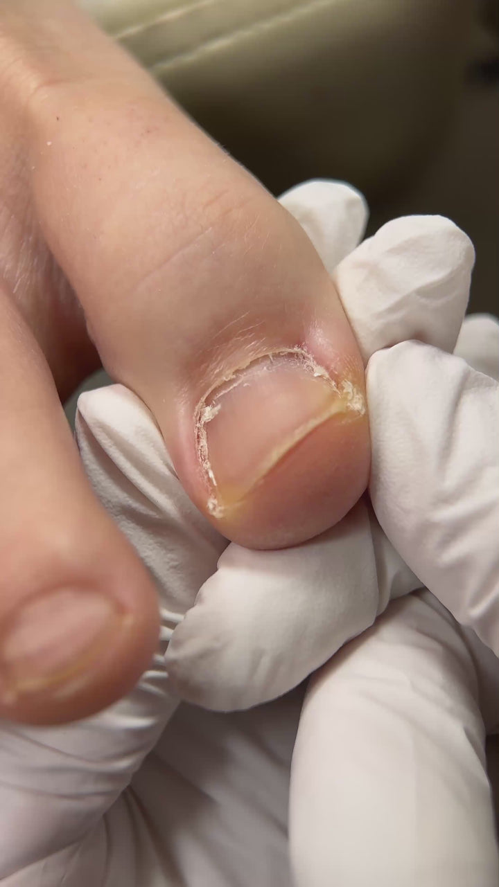 Ingrown toenail softener - 30 ml